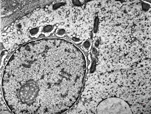 F,1y. | glycogenosis type II.(glycogen dissolved due to UA blockstaining) F,1y. | glycogenosis type II.(glycogen dissolved due to UA blockstaining)